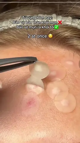 Ai hay trang điểm hay bị mụn rồi tay hay táy máy thì dơ tay. @@FOCALSKIN VIETNAM #mụn #munjcalskin #focalskinvn #focalskincare 