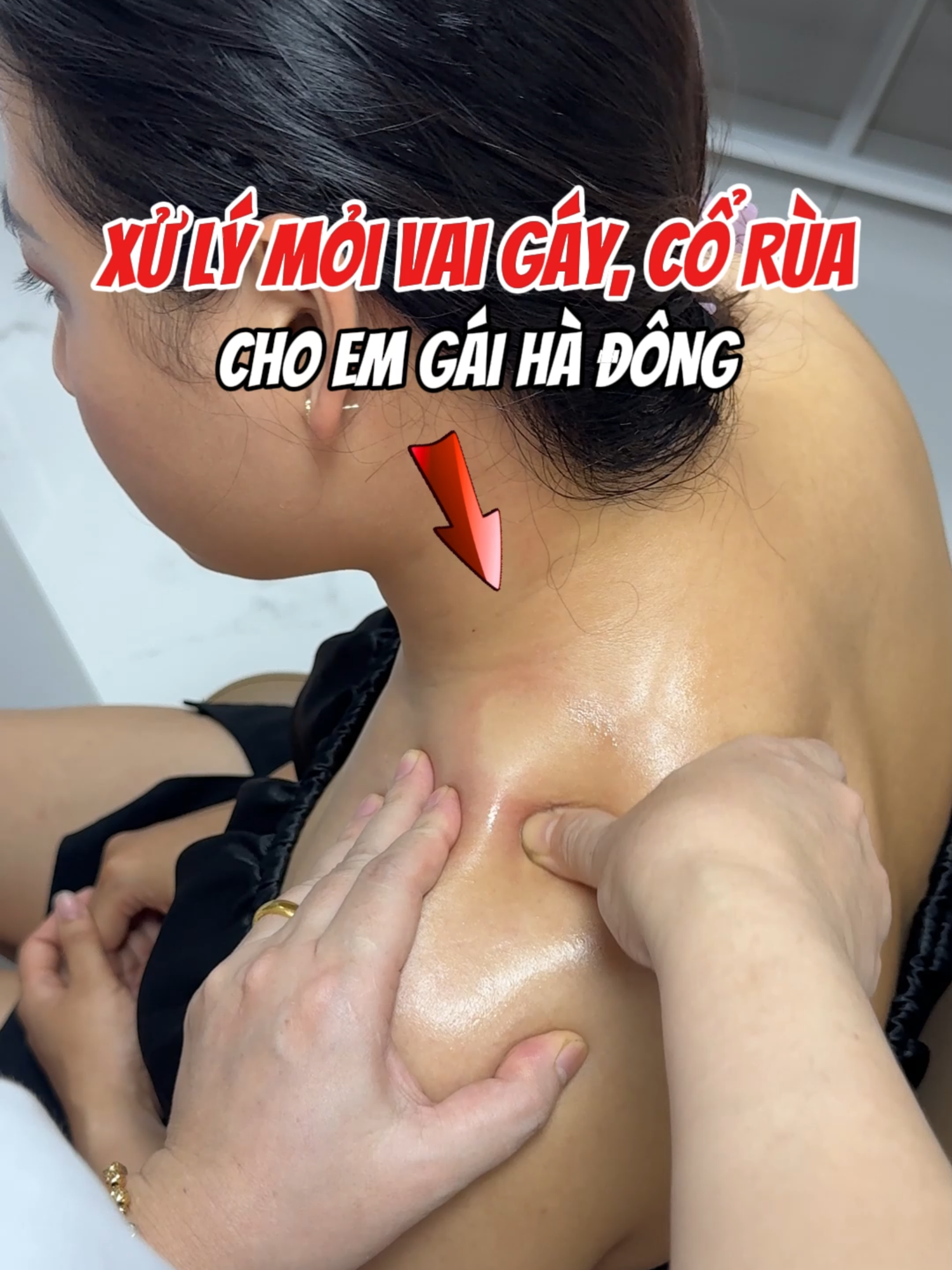 Xử lý mỏi vai gáy, cổ rùa cho em gái hà đông #daumoivaigay #corua  #trilieuvientam #xhuongtiktok #daudau #songkhoe #giaicoxuongkhop