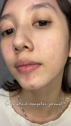 ini cara paling ampuh buat aku, kalo kalian gimana guys?  #drleo #drleoid #drleoclaymask #drleoacneessence #skincareindonesia 