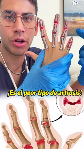 ¡Artritis de los dedos! Tenosinovitis estenosante ¡Una solución total!#painrelief #clearzal #clearzalgel #fyp 