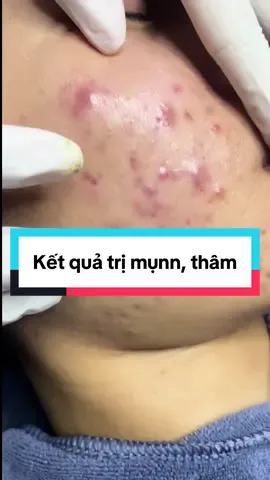 Double Peel thúc đẩy tăng luân chuyển da, hỗ trợ cải thiện hồng ban sau viêm trên nền da mụnn khá tốt #trimuntritham #spaxulybeauty #bslydalieu 