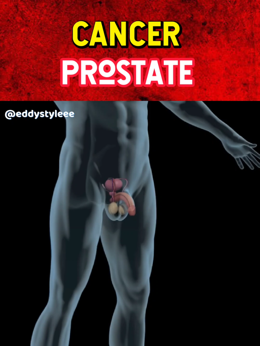 #chirurgie #medecine #prostat #cancer  