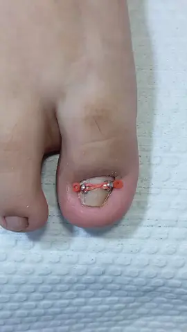 #viral #chincha #luzmipodologia👣💕 #correctoresdeuña