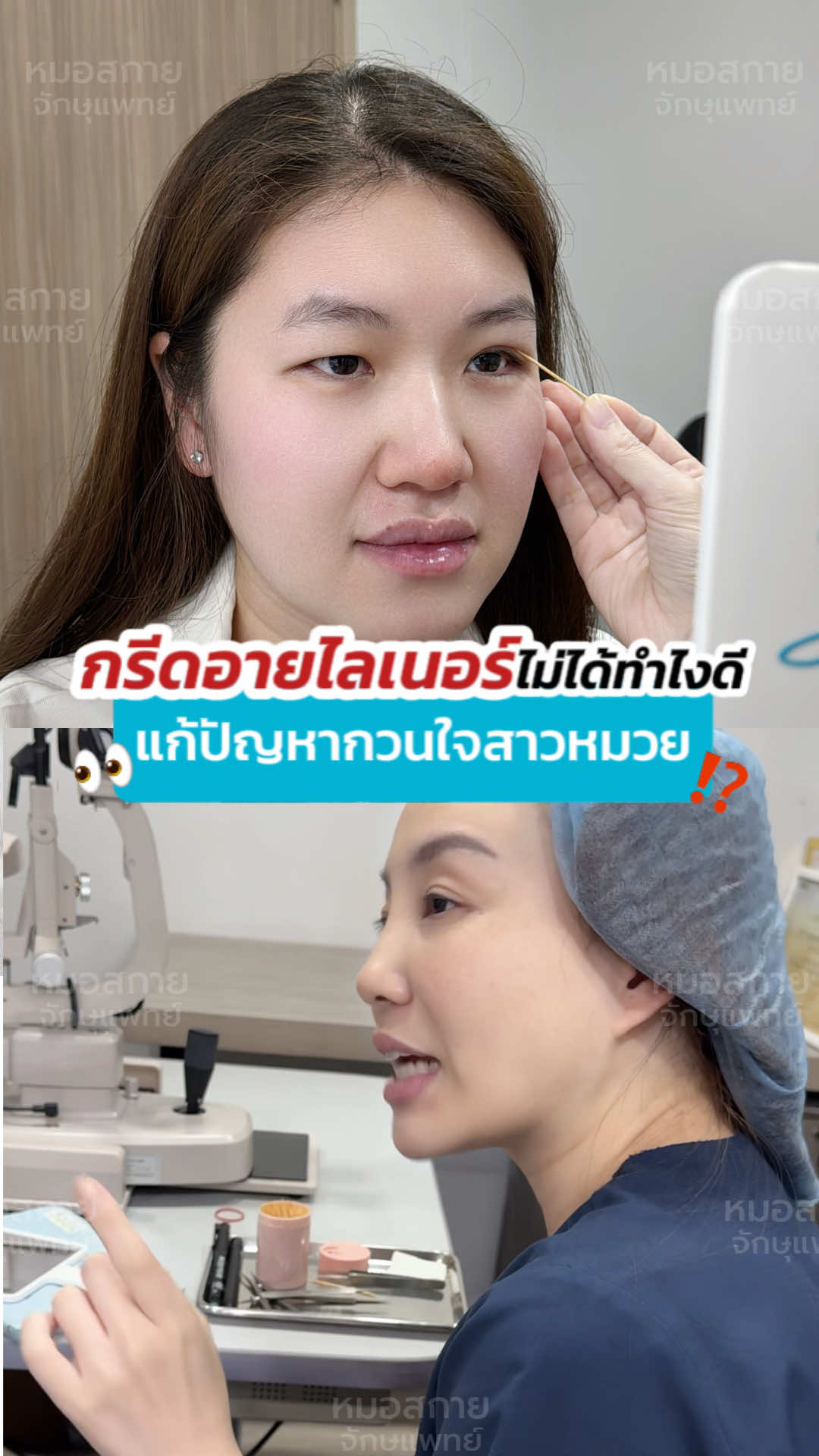 กรีดอายไลเนอร์ไม่ได้ทำไงดี ⁉️ #รีวิวทําตาสองชั้น #ไขมันตาเยอะ #ชั้นตาหลบใน  #sweeteye #หมอสกาย #จักษุแพทย์ #ศัลยกรรมตา #รีวิวตาสองชั้น #skyclinic #สกายคลินิก   #ทำตาที่ไหนดี #หนังตาเยอะ #หนังตาตก