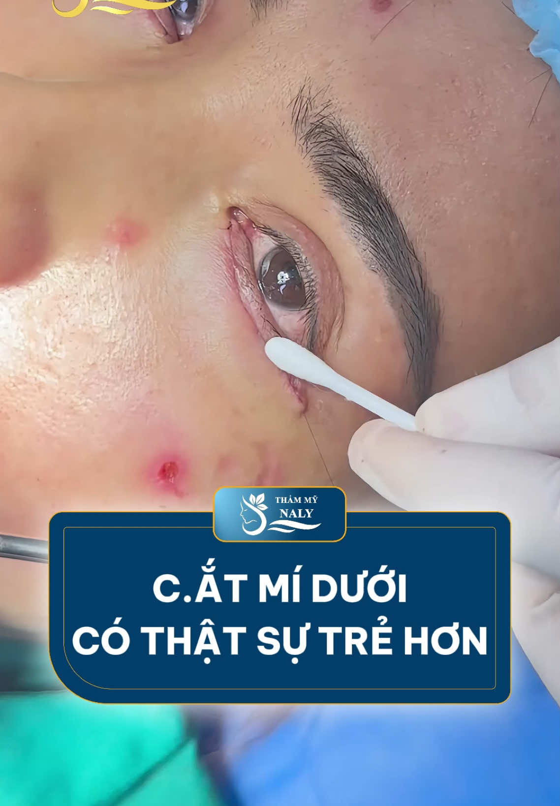 Dừng lại vài giây, xem ngay Căt mí dưới Xoá nhăn khâu giấu chỉ nhà Kiều ạ #trendingvideo #T¡KTOKAwardsVN #viral #tiểu_phẫu #cắt_mí_đẹp_HN_SG #thammynaly #dr #pttm #cắt_mí_dưới