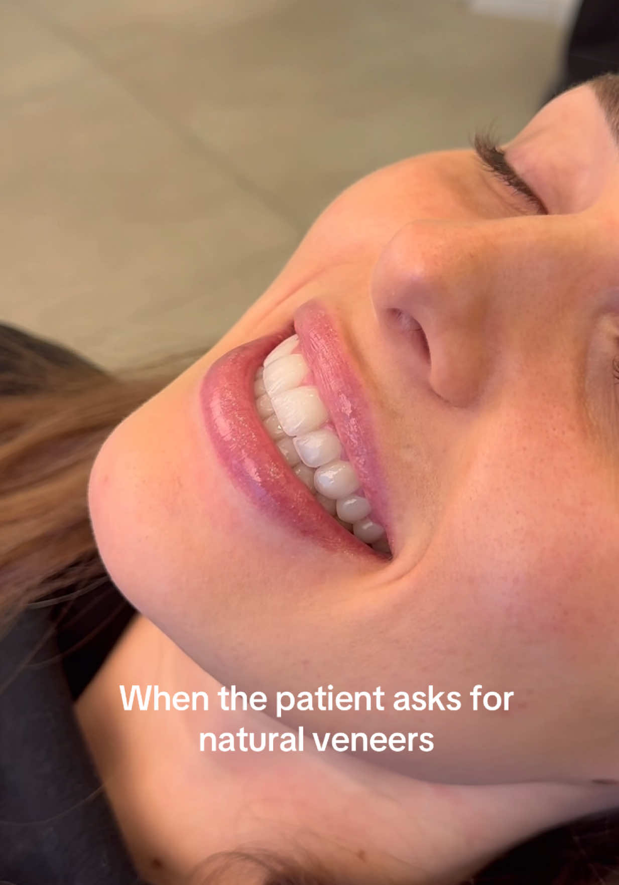 Smile makeover with natural veneers #veneers #noprepveneers #dentalimplants #dentist 