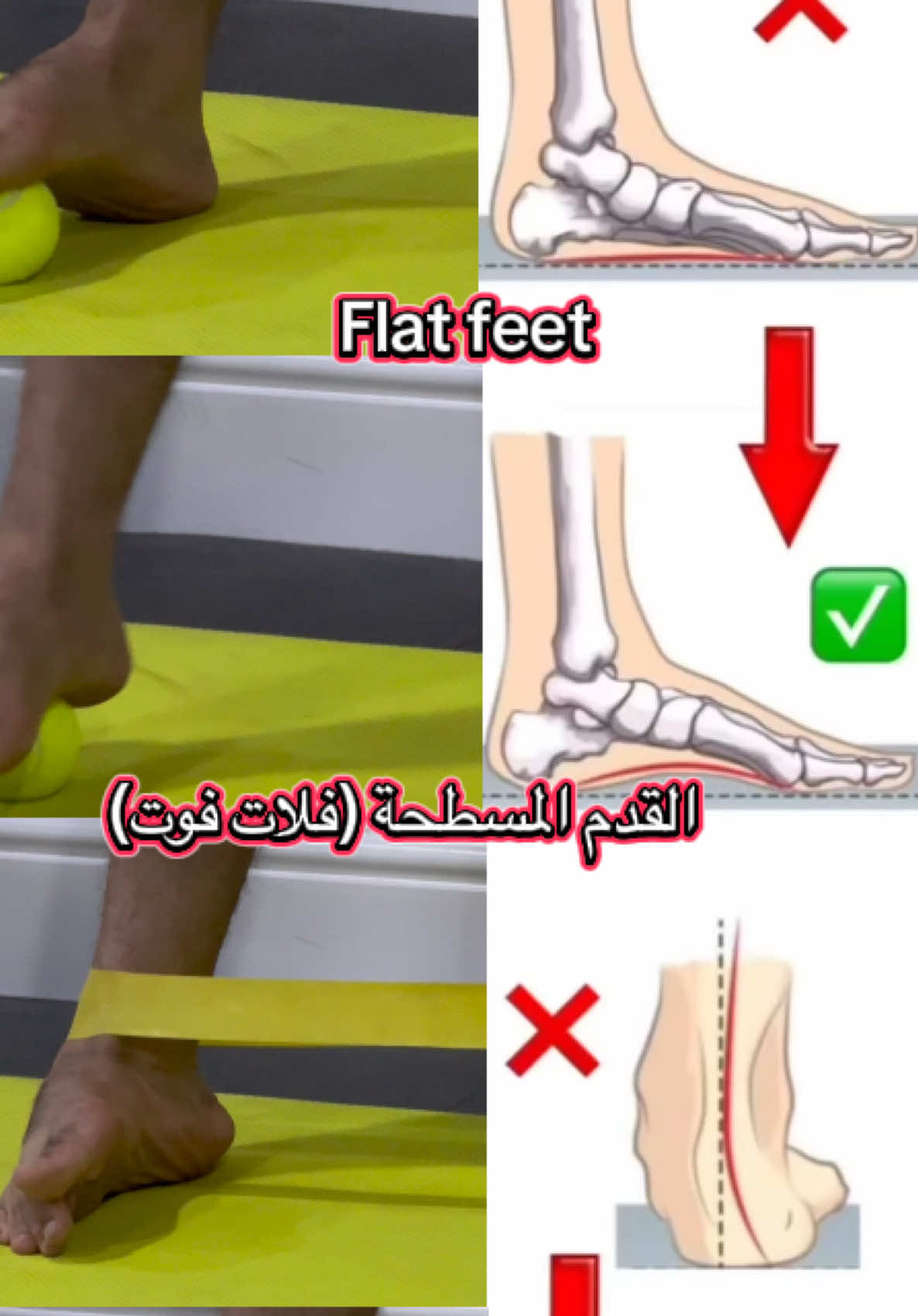 #مشاكل_القدم #فلات_فوت #flat_foot #flat_feet #تمارين_رياضية #gym #like #تمارين_منزلية #الانكل #مشط_القدم 