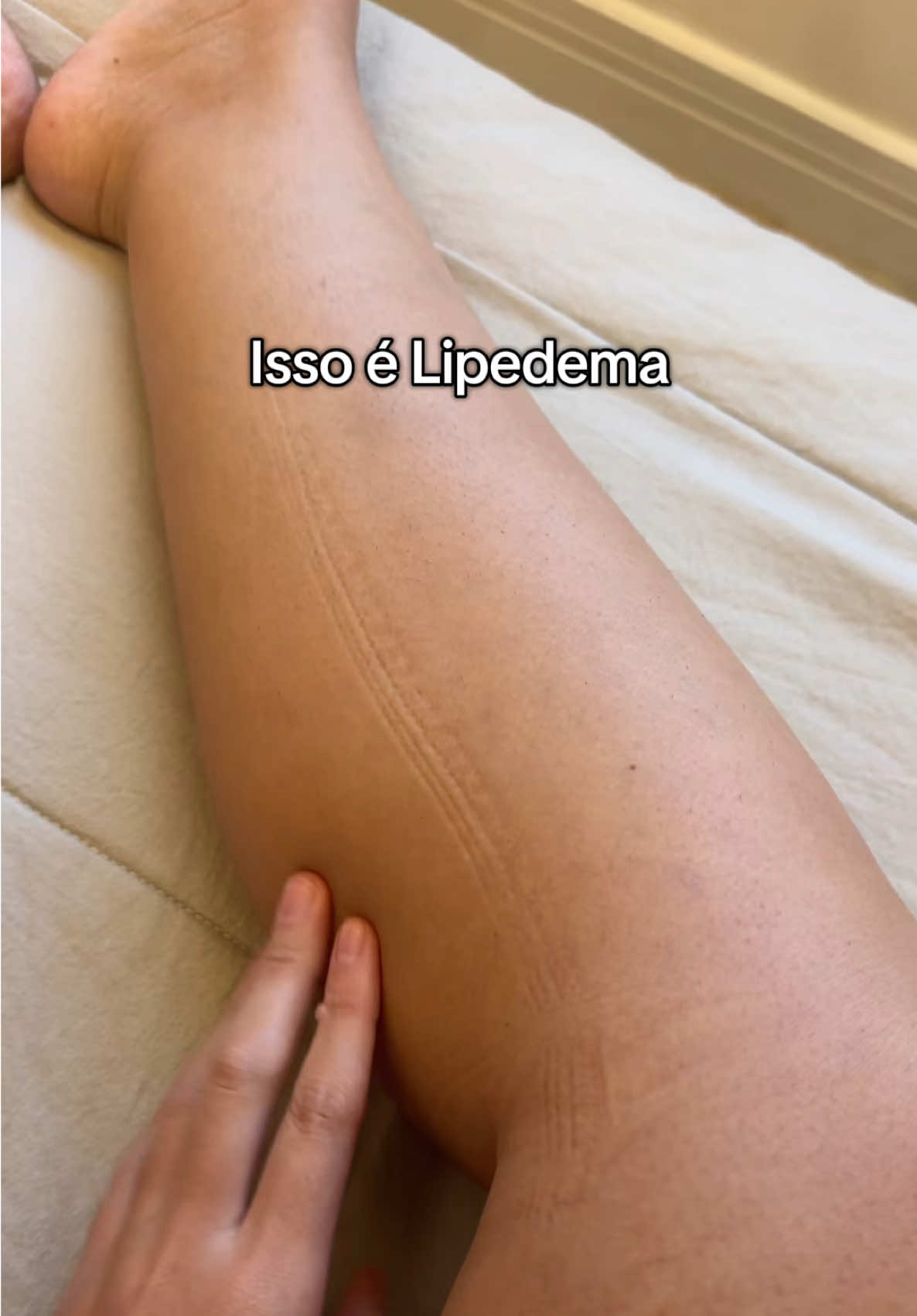 Quem tem as pernas assim comenta aqui para compartilharmos experiências 👇🏻👇🏻 #lipedema #lipedemabrasil 