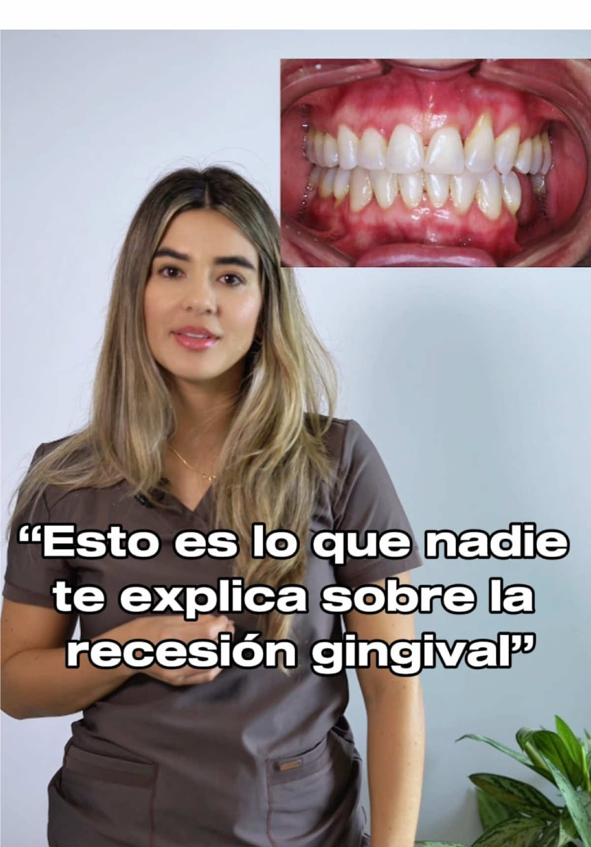 ¿Tus encías se están “bajando”? No es solo estética… es una señal de alerta. Puede doler, dar sensibilidad y hasta hacer que pierdas un diente. ¿La causa? No siempre es mala higiene. ➡️ Cepillado agresivo ➡️ Bruxismo ➡️ Ortodoncia ➡️ Genética Lo importante: detectarlo a tiempo. No lo ignores. Tus encías también hablan. 🦷 Agenda tu revisión. Prevenir es clave. #recesiongingival #odontologia #bruxismodental #dentista 
