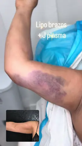 Contáctanos tel: 786-409-7823 #lipo #liposincirugia #florida #miami #jplasma #lipobrazos #braso #nanotransfermiami #postopmassage #mommymakeover #remociondebiopolimero #plasmagel #aumentodegluteosincirugia 