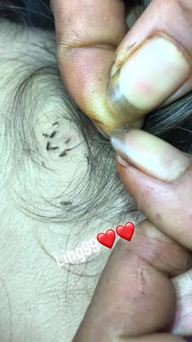 lice concentrated in one place#omg #lice #liceremoval 