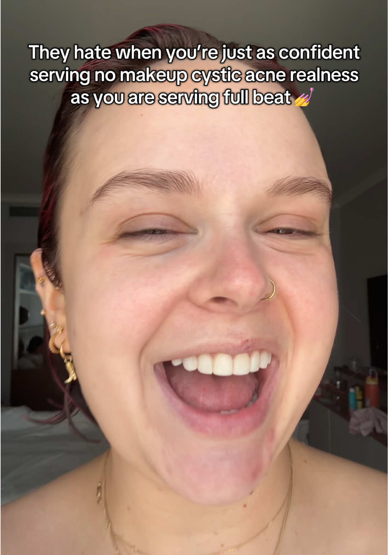 Me and Cystiana Karen Fitspatrick the third are gonna have a good time whether she’s out and about, or keeping cool under concealer 😉 #acne #acneskincare #cysticacne #transition #makeup 