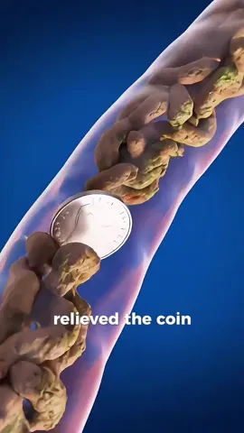What Happens if You Swallow a Coin?🤮🪝