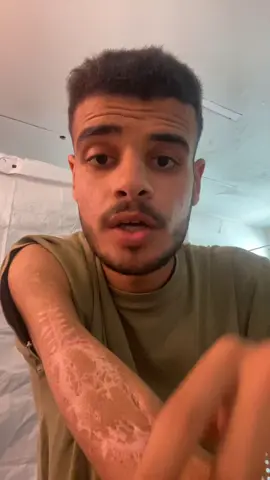 Save Mahmoud and his hand ‏#fyp #fup #viral #foryoupage #govirall #fypsy #fypg #fyyyp #frp #kids #business #fyyy #f #fyp #foryou ##foryoupage #fypppppppppppppppppppppppppppppppppp #viral #water #Home #food #job #usa #indonesia #dubai🇦🇪 #unfrezzmyaccount #support_me #dubaichocolate #foryou #fypシ #foryoupage #viralvideo #trend #explore #Love #support #helpme #life #family #saveus #tiktok_arab #palestine #rebuild #hope #future #dubai #usa #indonesia #tiktok #tiktokviral #fypdaily #momlife #baby #reallife #savelives #war #refugees #recovery #motherhood #voice #gaza #prayforus #helpnow #emergency #humanity #peace #rebuildhope