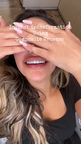 Composite veneers 🦷one session🥇 #compositeveneers #emaxveneers #dralaaelcheikh #مشاهدات #beirut 