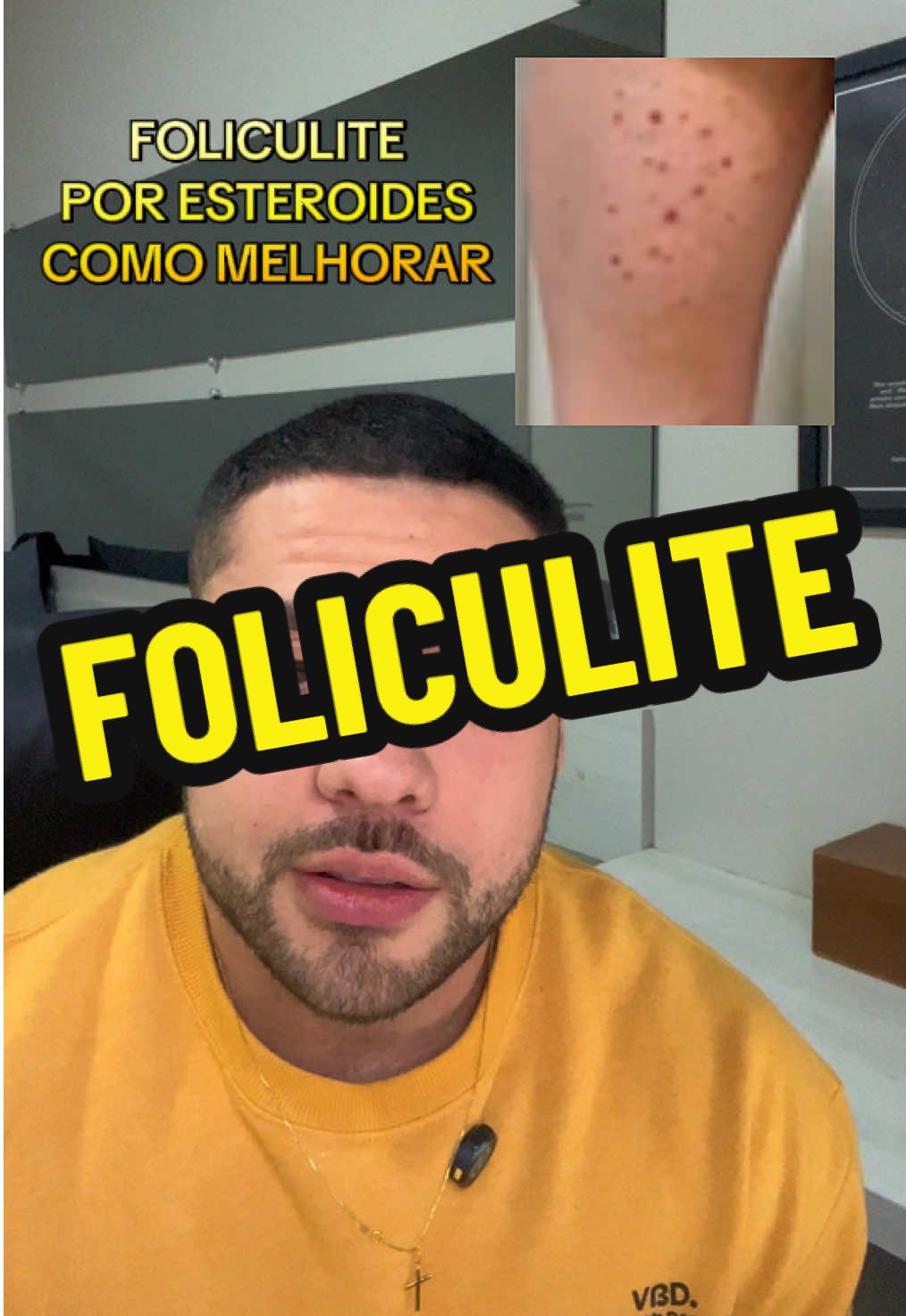 Foliculite em usuarios de esteroides #academia #musculação - Vídeo relatando utilização própria, sempre busque orientação de um médico especialista. 