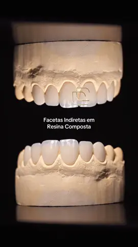 Durabilidade, resistência e o mais importante: naturalidade! Se você está buscando aquele sorriso que tanto sonhou, as facetas indiretas podem ser uma ótima opção! Com o meu método de aplicação, seu sorriso é esculpido fora da boca, evitando aquelas longas horas na cadeira do dentista. O resultado é um sorriso do jeito que você sonhou!  