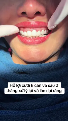 Đường lợi k cân và cách xử lý#nhakhoanganphuong #vietkieu #vietkieu #chuaviemloi #phauthuatcuoiholoi #drtuan #