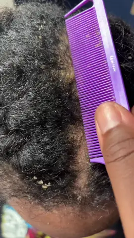 Seborrheic dermatitis is what I read what it’s called because she has badddd dry scalp anyway it’s so satisfying I comb my sisters hair all the time . What can we do ? #dryscalp #flakyscalp #fyp 