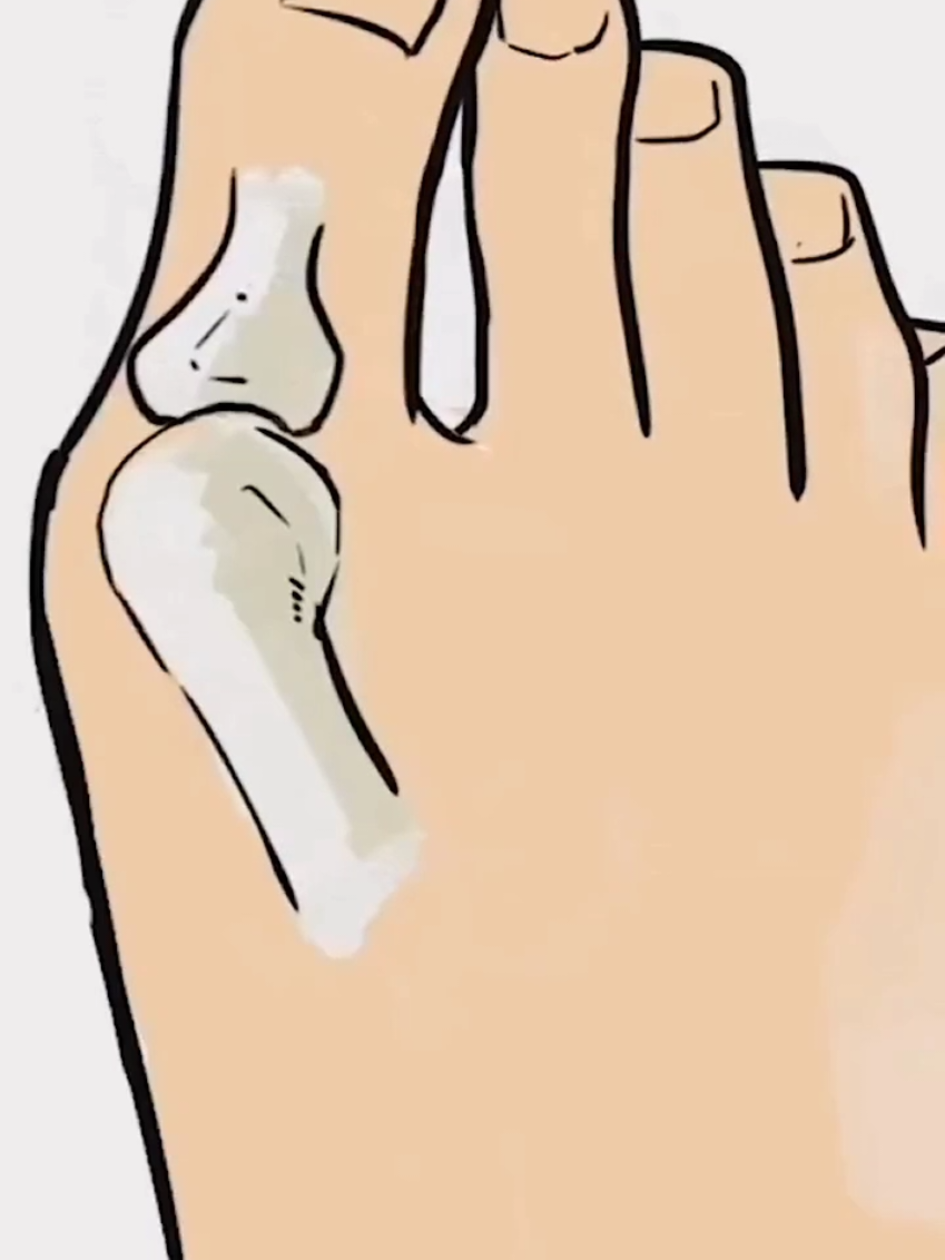 Dê uma olhada em Bunion Corretor Splint Big Toe Straightener De Dedos Ajuste Knob Hallux Valgus Correção Do Pé Ortopédico Cuidados Com Os Pés por R$59,99. Compre na Shopee agora! https://s.shopee.com.br/3frluXycne