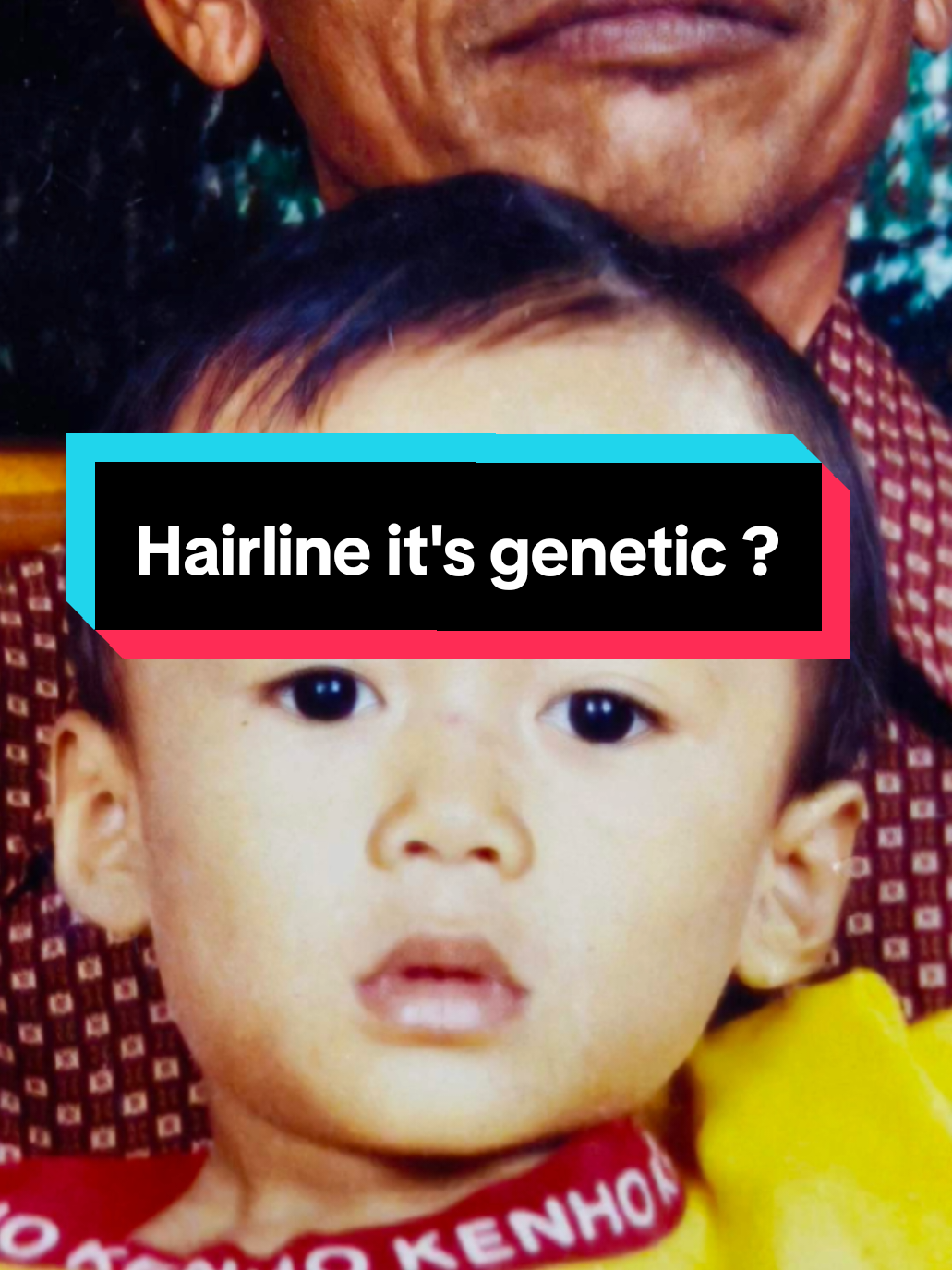 Genetic ? #minoxidil #hairline #genetics #hairgrowth 