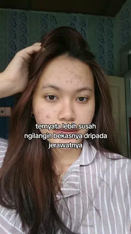 ini hrs pke apa ya?  #acne #jerawat #bekasjerawat #acnefighter 