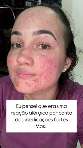 É gente esse ano tem sido desafiador!!! Tive 5 crises de “espinhas” no intervalo de 1 mês … achava que era uma reação alérgica  por conta das medicações fortes que tenho tomado.. Porém fiz biópsia da pele e descobri que tenho ROSÁCEA… acredito que por tudo que tenho passado desencadeou essa bendita !!! Mas graças a Deus minha pele já voltou 90% , ainda fico com as bochechas rosinhas/avermelhadas mas graças a Deus nunca mais tive essa crise com “espinhas” 🤍 #rosacea #tratamento #tratamentopele #corticoide #espinhas #rosácea 