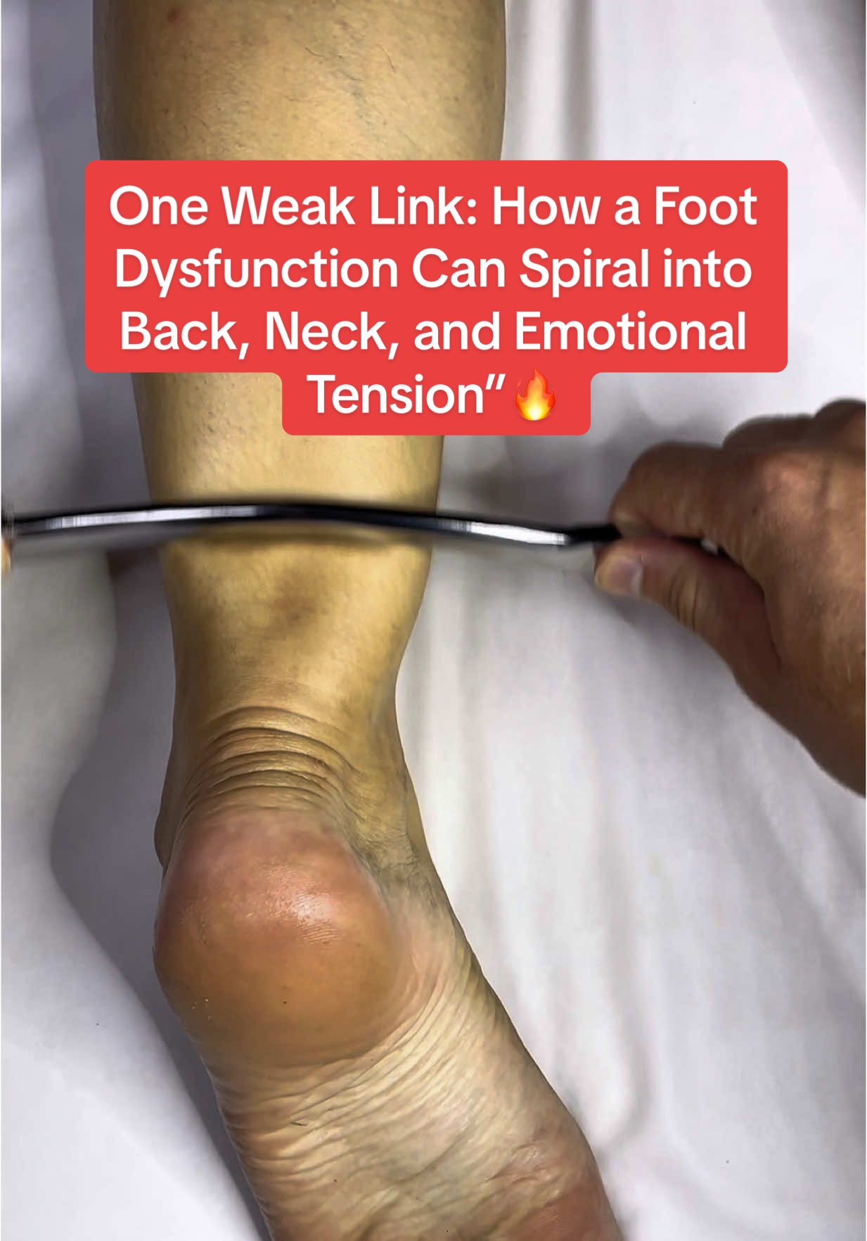 One Weak Link: How a Foot Dysfunction Can Spiral into Back, Neck, and Emotional Tension” most people don’t realize that a small dysfunction in the foot or Achilles tendon can throw off the entire kinetic chain. When your foundation is unstable, your body begins to compensate—leading to tight hips, spinal misalignment, jaw clenching, and even emotional stress. 👣 A collapsed arch, tight Achilles, or misfiring foot muscles send confusing signals to the brain, creating a constant state of tension throughout your nervous system. This kind of tension-related myopathy can affect how you move, breathe, and even how you feel. This is more than a foot problem—it’s a system-wide imbalance. And it won’t go away until the root is corrected from the ground up. 🧠 When you stabilize the feet, you release tension from the spine to the skull—and beyond 🔥🔥🔥🔥#OneWeakLink #FootDysfunction #KineticChain #BodyAlignment #NeuroKinesiology #TensionMyopathy #AchillesPain #BackPainRelief #NeckPainHelp #SomaticHealing #RootCauseHealing #WholeBodyBalance #EmotionalTensionRelease #FeetToSpine #MindBodyConnection #PostureCorrection #PainFromTheGroundUp #StructuralHealing #HolisticTherapy #footpain #footpainrelief #plantarfasciitis 