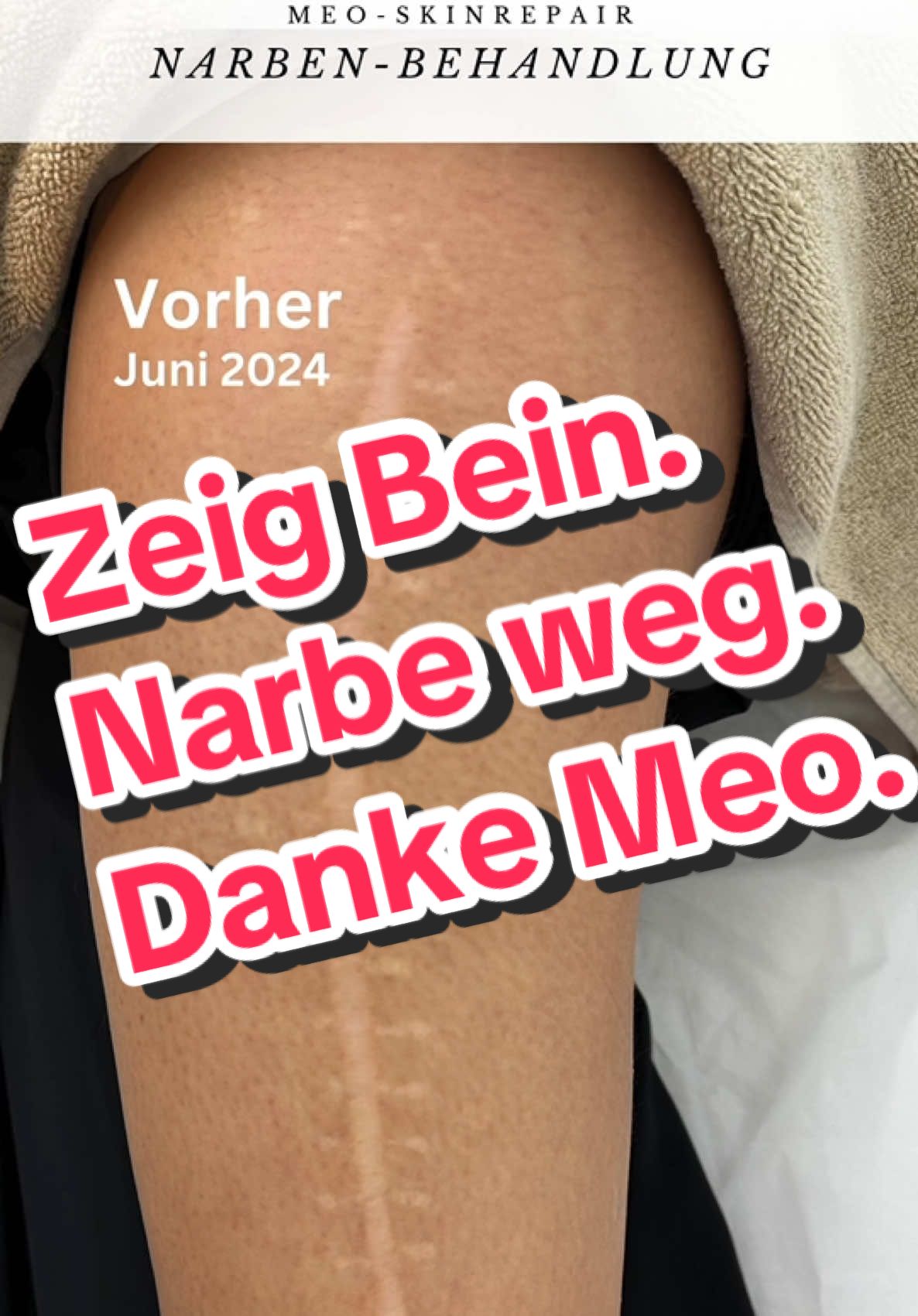 Heute zeige ich euch ein wirklich besonderes Ergebnis einer Patientin aus Hessen. Sie kam im Juni 2024 zum ersten Mal zu mir. Ihre Narbe am Oberschenkel stammte aus ihrer Kindheit, war durch einen Unfall entstanden und hatte sich über die Jahre vergrößert. Heute, im Juni 2025, war sie zur fünften Sitzung bei mir. Davor war sie zuletzt im September 2024 da. Wenn man sich anschaut, wie die Narbe vor der ersten Sitzung aussah und wie sie sich jetzt verändert hat, ist das wirklich beeindruckend. Sie ist überglücklich mit dem Ergebnis und kann kaum glauben, wie sehr sich ihr Hautbild verbessert hat. Und das Schönste ist: Ihre Freundin, die mich damals auf Instagram entdeckt und ihr empfohlen hat, möchte jetzt auch mit ihrer eigenen Narbe zu mir kommen. Ich freue mich riesig über dieses Vertrauen und bin gespannt, wie es bei ihr weitergeht. Bleibt dran, es kommen noch viele spannende Entwicklungen. Und wer weiß, vielleicht ist deine Geschichte die nächste. #MeoMethode #Narbenbehandlung #Erfolgsgeschichte #SkincareJourney #HappyPatient #SkinResults #BeautyClinic #Inspiration #ScarTreatment #BeforeAndAfter #Confidence #NatürlichSchön #KöDüsseldorf #Narbenfrei #Mutmacher #HeilungIstMöglich #hautveränderung 