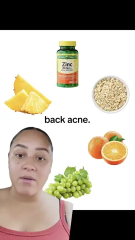 This really helped my acne, just look at my before/after at the end #acne #backacne #zinc #acnetips #acneremoval 
