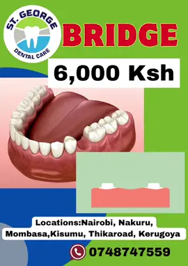 Bridge (6k per unit) permanent teeth replacement  #busiatiktokers #eldorettiktokers #nakurutiktokers #HOMABAYTIKTOKERS #kerugoyatiktoker #kisumutiktoker #karatinatiktokers #LUO #KENYANTIKTOK #eldorettiktokers #rongainairobi #goviral #mobasatiktokers ##ukundatiktokers #nyeritiktokers #karatinatiktokers #trending #embutiktokers #merutiktokers #murangatiktokers #naroktiktokers #naivashatiktokers @moyadavid @DEM WA FACEBOOK 2 