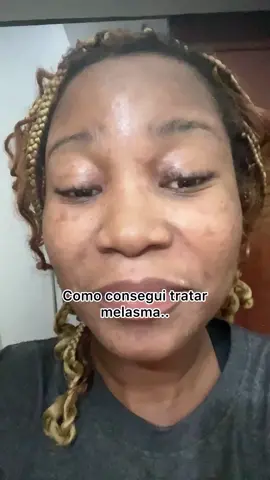 Vamos todos superar isso? Sim ou sim? #melasma #melasmatreatment #pele #peleseca #pelesaudavel #acneskin #skincare 