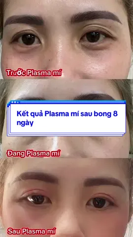 Plasma mí sau bong 8 ngày #plasmafibroblast #xuhuong2025🍀🍀 #kim7magnum #longmaysoi #phunmoitanvien #khuthammoi #plasma 