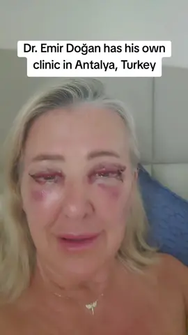 Dr. Emir Doğan has his own clinic  in Antalya,Turkey. He is an ophthalmologist and oculoplastic surgeon who specialises in eyes only and why I chose him for my upper ans lower blepharoplasty #blepharoplasty #antalya #turkey🇹🇷 #fyp 
