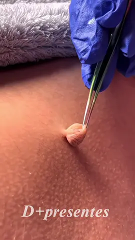 pomada para verrugas 