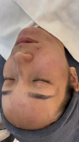 Một làn da 2 số phận. Da sau peel 1 lần khách mê luôn #mụn #peelda #munan #peel 