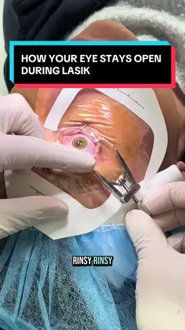 We hold your eye open during LASIK by using a gentle speculum!! #tiktok #lasik #lasikeyesurgery #vision #visioncorrection #eyes #eyesurgery #eyesurgeon #surgeonsoftiktok #surgery #viral #doctor #doctorsoftiktok #glasses #ophthalmology #ophthalmologist #doctors #surgeons #fyp 