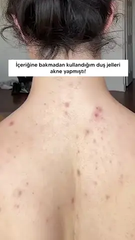 Cildinde akne varsa çözümü Bodylita! 😍