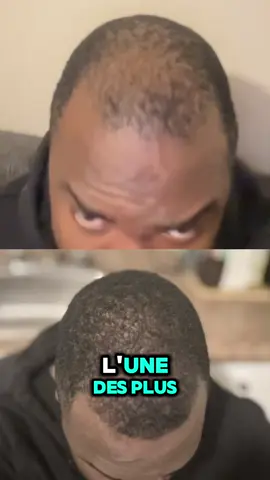 Des fous résultats en peu de temps pour ce clients🤯🤯 #CapCut #HairGrowthRoutine #NewgrowthSerum #HairTok #HairlineCare #MinoxidilJourney #HealthyHair #HairCareTips #TikTokHair #HairlineRestoration #ThinningEdges #BeforeAndAfter 