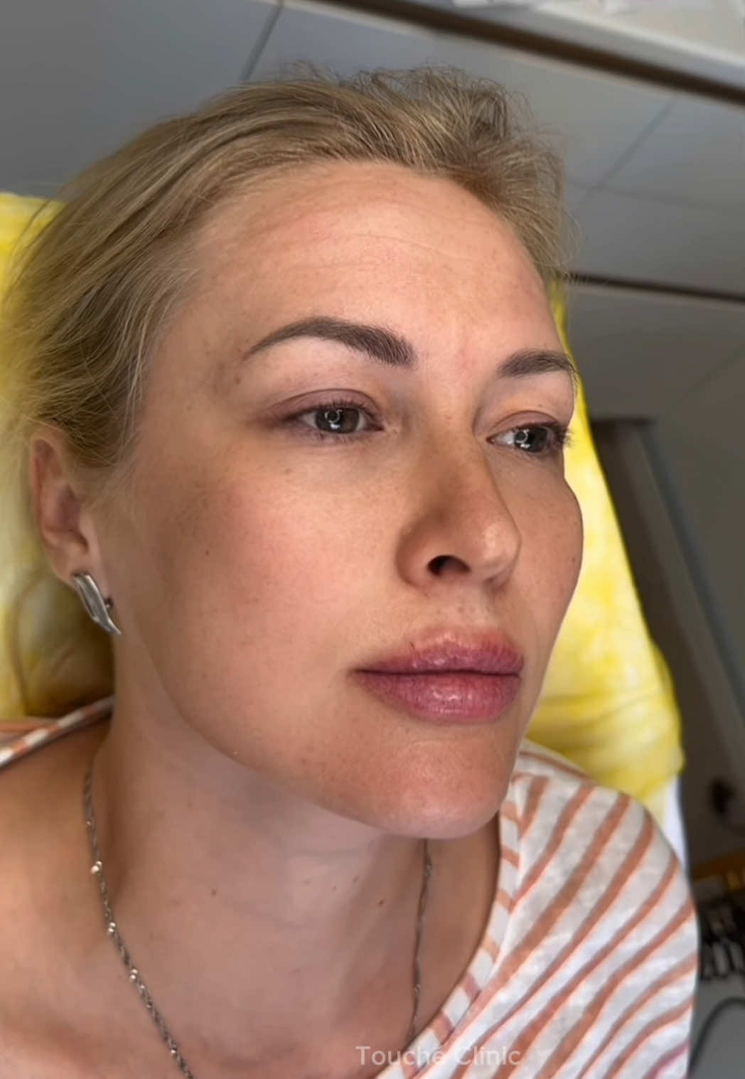 Non-surgical FULLFACE