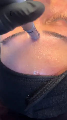 This is your sign to try Microneedling ✨ ✨ Glow up season is here! Microneedling targets: ✅ Acne scars ✅ Fine lines ✅ Stretch marks ✅ Uneven skin tone Let your skin heal, boost collagen, and feel brand new 🌿 #Microneedling #SkinGoals #FacialTreatment #LondonFacials #ZafirahBeauty #CollagenBoost #SkinCareRoutine  #microneedlingface 