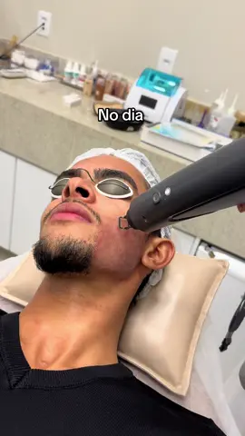 Acompanhem o processo… . . . #tratamento #pele #resenha #foyoupage #fyp #fyp #cicatrizes #cicatrizesdeacne 