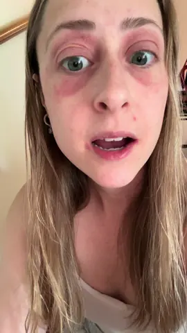 PT 2 of the eye saga #contactdermatitis #housemystery #eyeliddrama #allergies 