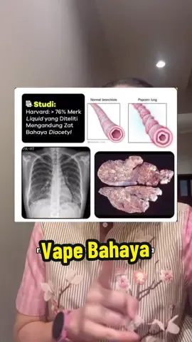 Siapa bilang vape itu aman? 🤨 #vape #rokok 