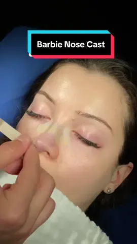 #barbienose in Istanbul 👃🏻🇹🇷 #rhinoplastyturkey #nosejob #barbienose #rhinoplastyistanbul #nosejobcheck #rinoplastia #nasenkorrektur #cindynose #nosejobturkey #nosejobistanbul 