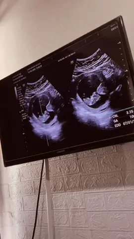 Masyaallah udah mau masuk 3 bulan,makasih sudah hadir di perut ibu nak🥹🫶🏻#CapCut #hamil #semangatpejuanggarisdua #usg #fyp #viral