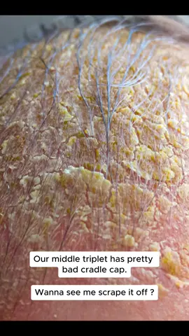Tom has cradle cap, eczema, and acid reflux. We use medicated shampoo and weekly scrapes, but it just keeps coming back. What do you guys do for cradle cap ? #cradlecap #newborn #triplets #momtok #babytok #dadtok #scrape #fyp #fypシ #baby #babyboy #eczema #acidreflux 