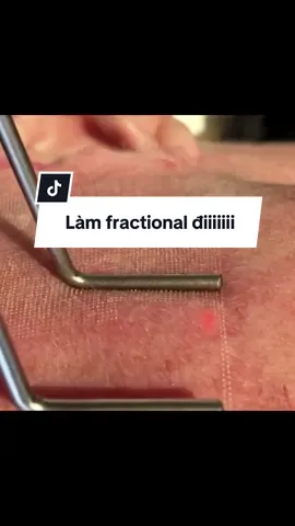 Mùa mưa đến ròi nhả vía cho mấy bà làm fractional co2 nha #reviewlamdep #BeautyTok #skincare #fractionallaser 