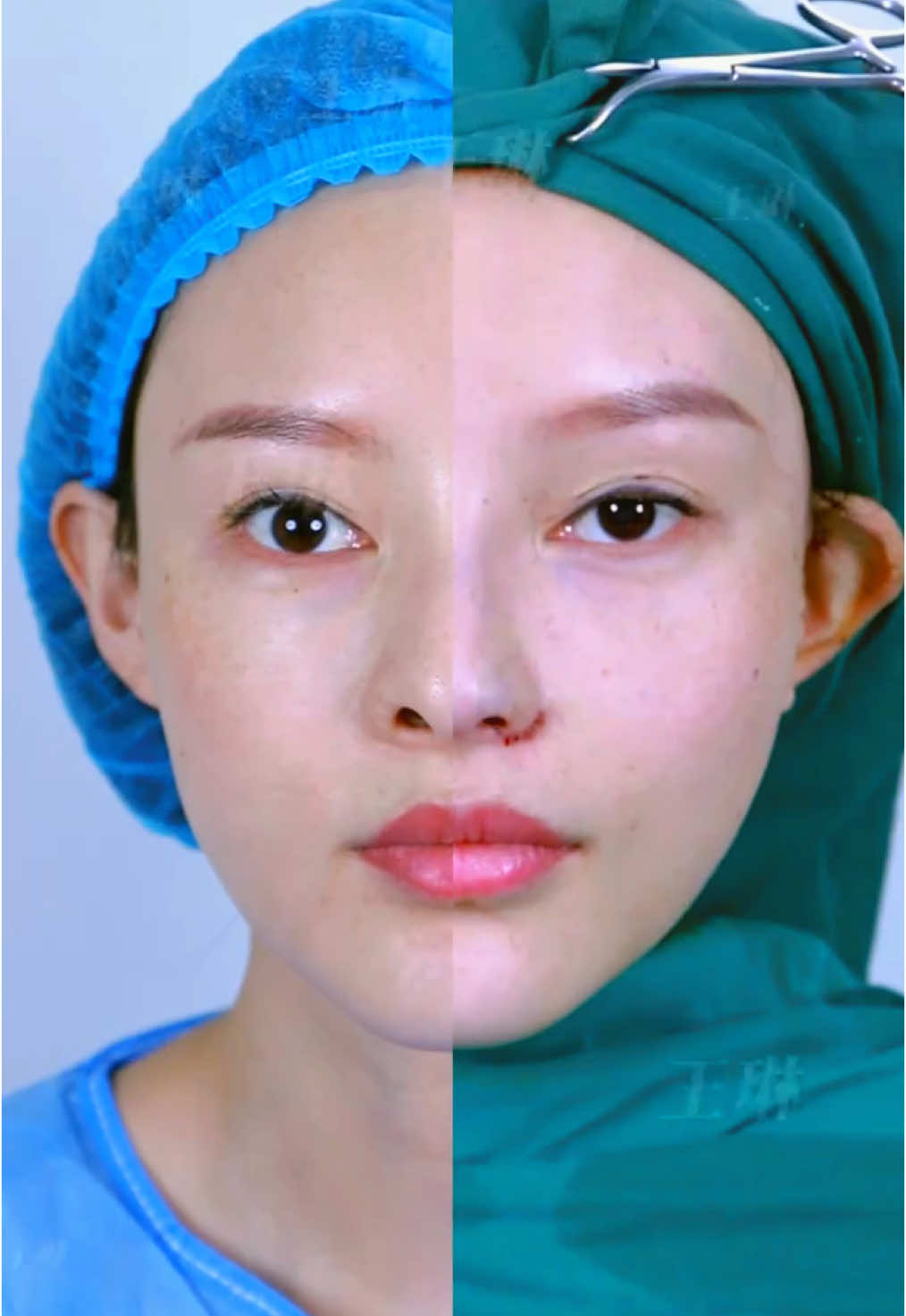 Nose tip reduction surgery, give you a beautiful and exquisite nose.#整容 #逆袭 #rhinoplasty #变美 #医美 #肋骨鼻 