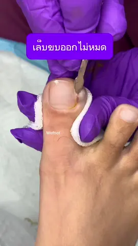 เล็บขบออกไม่หมดไม่ต้องกังวน  เอาเล็บขบออกหมดไม่เหลือตอ#ingrowntoenail #wefootตัดเล็บขบรักษาเล็บเชื้อรา #ตัดเล็บขบมียาชา #ตัดเล็บขบมียาชา #เล็บขบ #ตัดเล็บขบ #เล็บขบหนักมาก #เล็บขบอักเสบ #wefootตัดเล็บขบสุดรากเล็บ 
